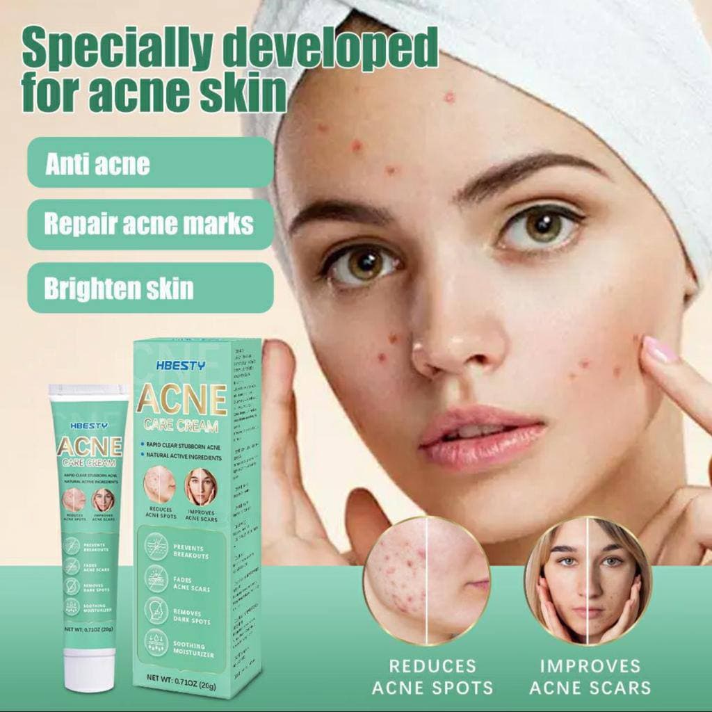 HBESTY ACNE REMOVER CREAM - image 1